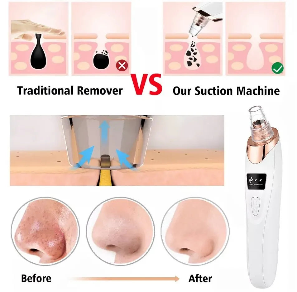 5-in-1 Blackhead Remover Machine – Rechargeable Face Vacuum with 5 Heads